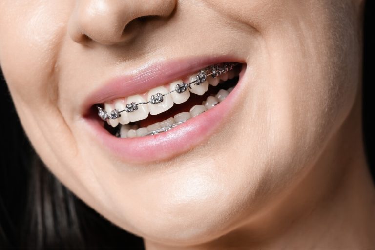 Bráquetes Autoligados | Odontologia Almeida Prado