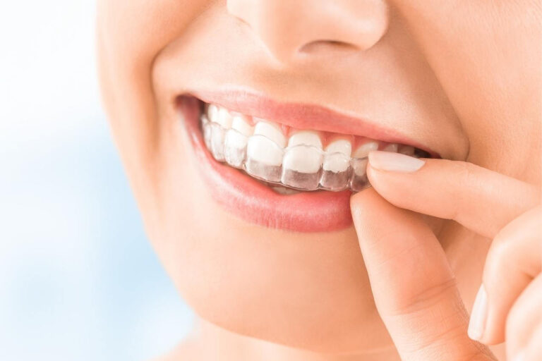 Invisalign® | Almeida Prado Odontologia