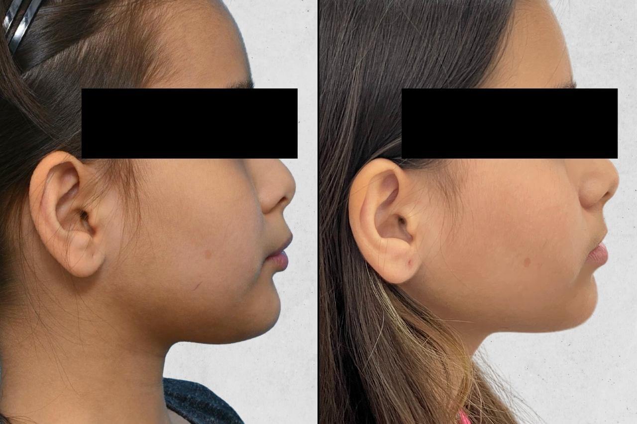 Ortopedia Facial | Almeida Prado Odontologia
